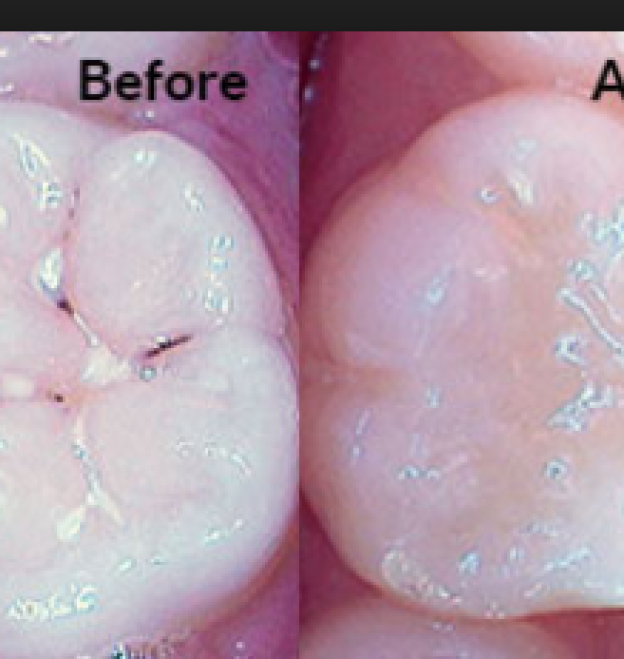 The Importance of Dental Sealants for Kids & Adults